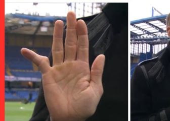 La atrofia de un portero en un dedo impacta a Inglaterra