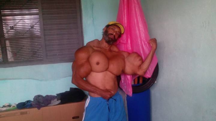 Así quedó el Hulk de Brasil al inyectarse aceite en el bíceps