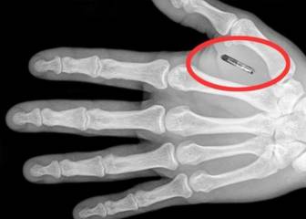 Proponen implantar microchips para combatir el dopaje