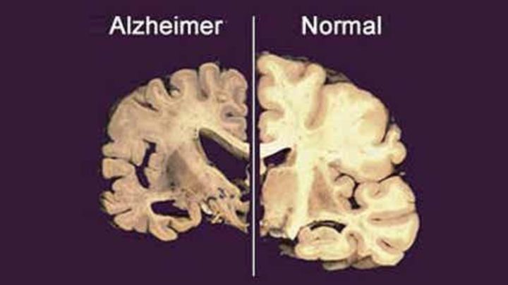 ¿La falta de sueño está relacionada con la aparición de alzhéimer?