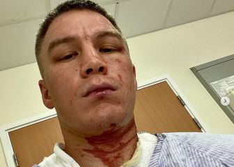 Un boxeador es atacado con ácido mientras entrenaba en Reino Unido