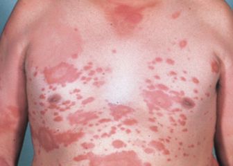 Lepra se localiza en 21 estados de México