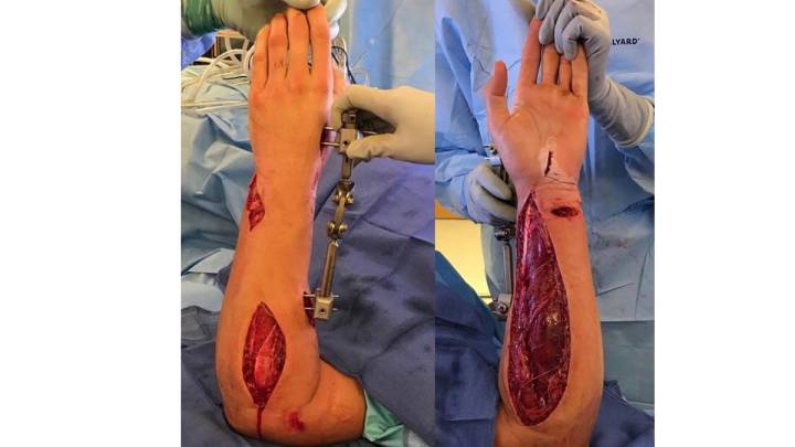 Imagen del brazo de Roczen durante la operación tras su accidente en el AMA Supercross de Anaheim.