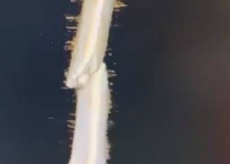 Márquez muestra los doce clavos que lleva en el brazo