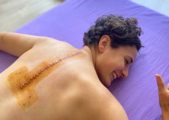 Ana Carrasco enseña la enorme cicatriz de su operación