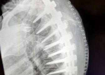 Carrasco muestra los tornillos en su espalda y anuncia novedades