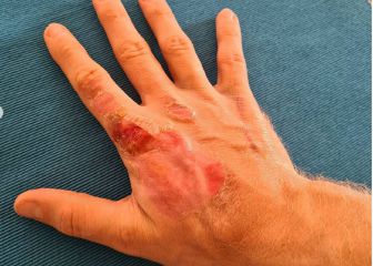 Así está la mano derecha de Grosjean tras el accidente