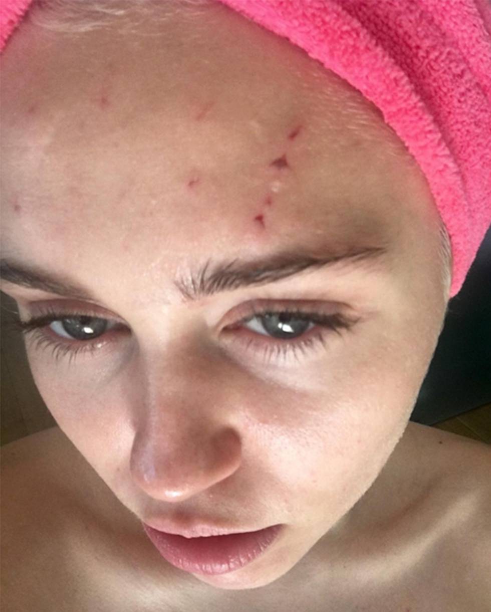 Miley Cyrus muestra las heridas por el 'ataque' de su gato