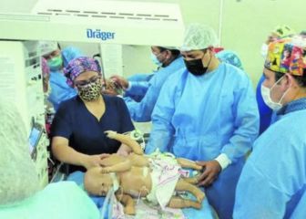 Separan a bebés siameses en Arequipa tras una larga y curiosa intervención