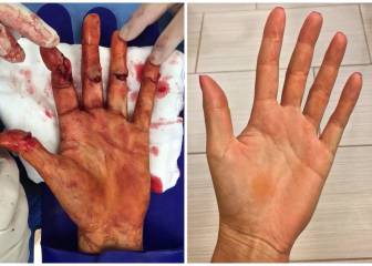 El milagro de Kvitova: así estaba su mano hace 9 meses