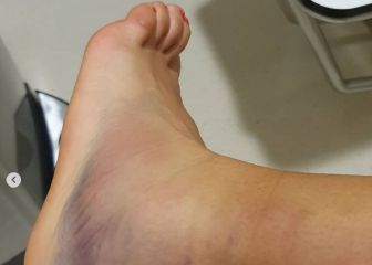 Así quedó el tobillo de Flipkens por un anuncio mal colocado