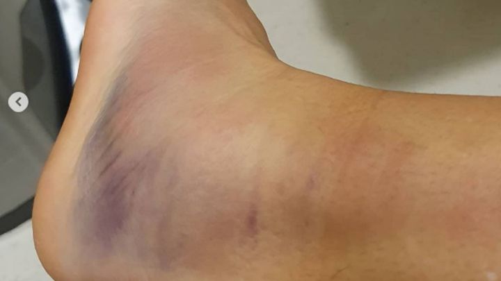Imagen del tobillo de Kirtsen Flipkens tras su lesión en el torneo de Abu Dabi.