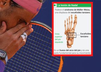 El síndrome de Müller-Weiss, la dolencia que atormenta a Nadal