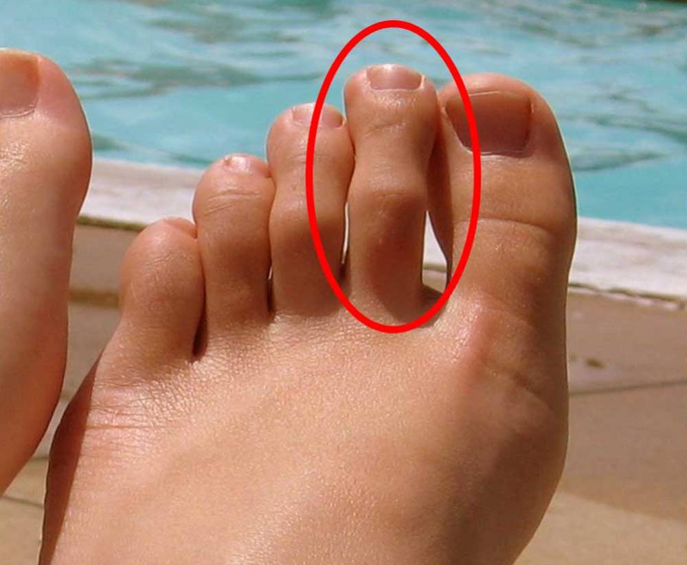 Â¿Tienes este dedo del pie mÃ¡s largo? Â¡Pues ten cuidado!