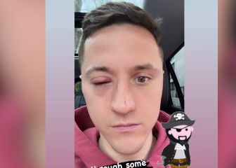 La reacción de la mujer de Ander Herrera al ver la infección del jugador en el ojo