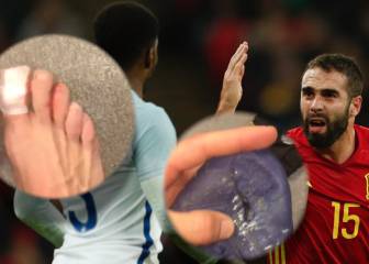 Carvajal shows off battle scars